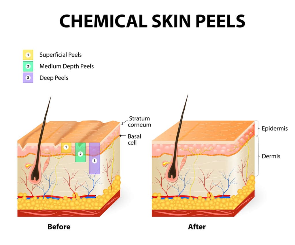 labeled cross-section diagram of skin showing superficial, medium, and deep chemical peel depths