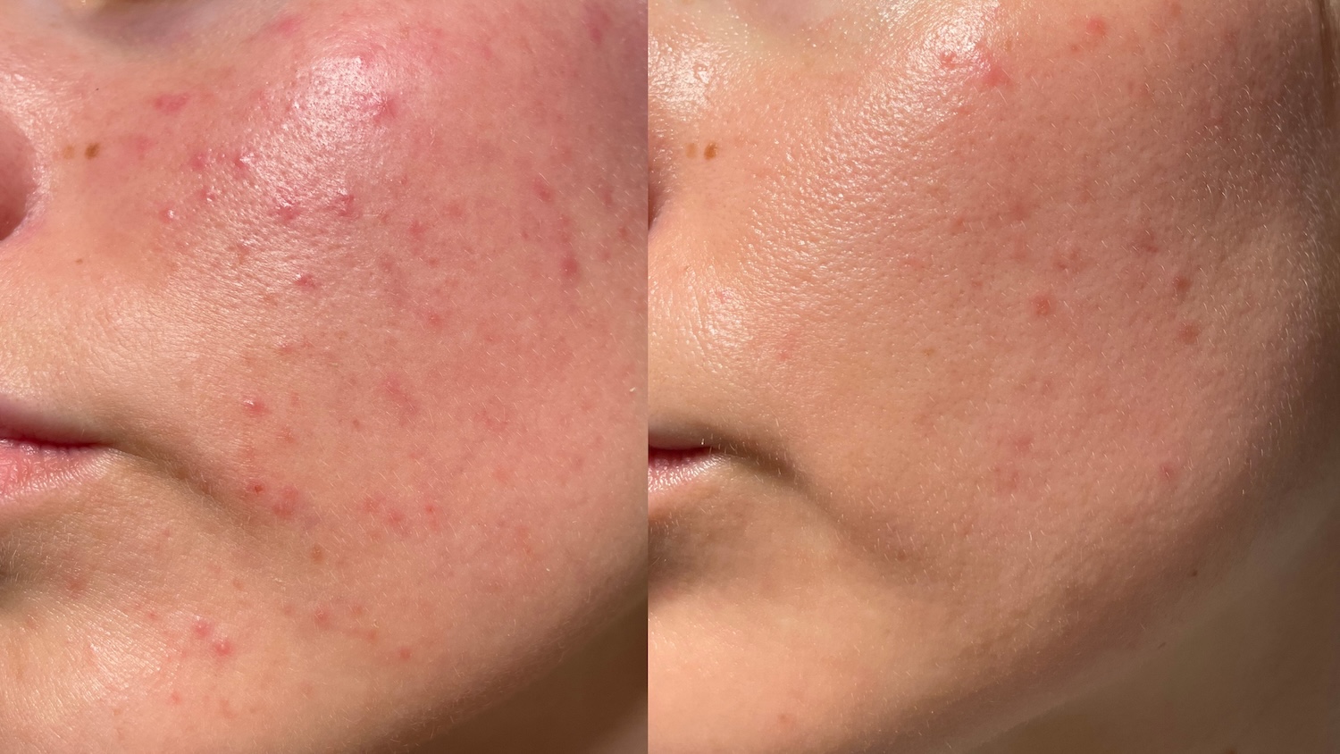 side-by-side close-up of facial skin showing redness and small bumps on the left and a clearer complexion on the right
