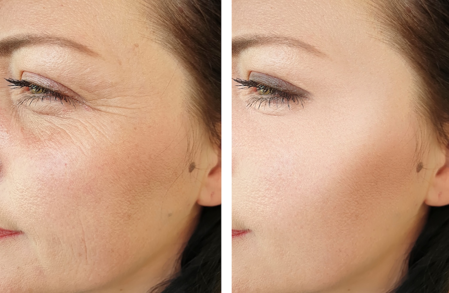 side-by-side close-up of a woman’s face showing visible wrinkles on the left and smoother skin on the right
