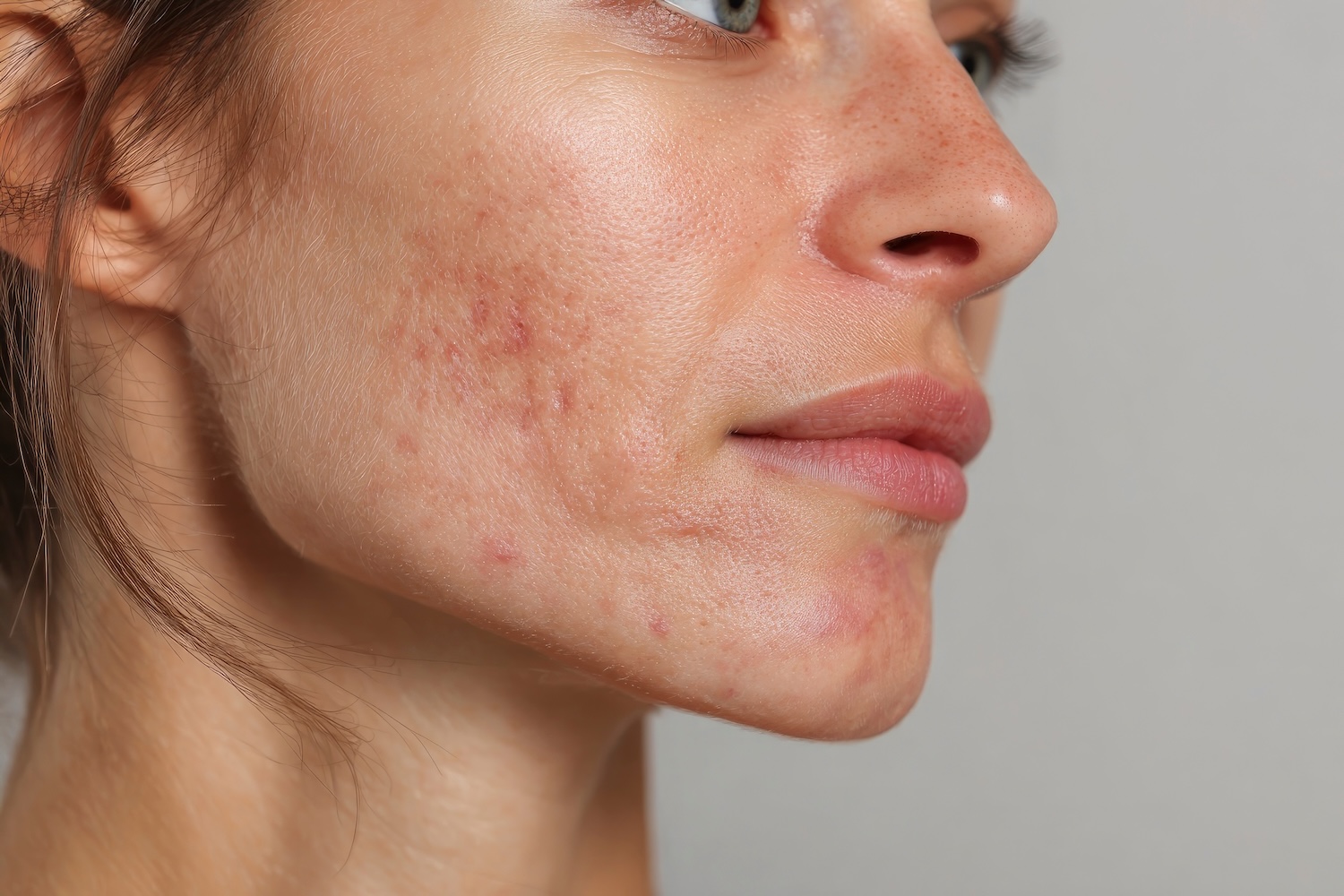 close-up of a woman's cheek and jawline with visible acne marks and textured skin