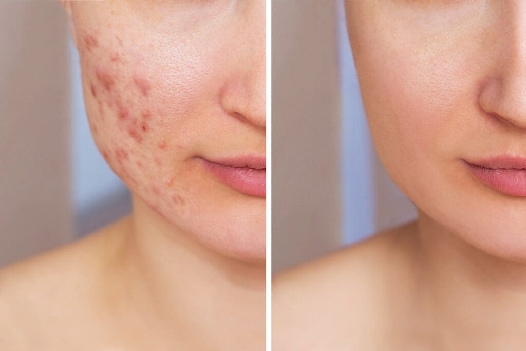 side-by-side comparison of a woman’s cheek showing acne scarring before treatment and smoother, clearer skin after laser scar removal