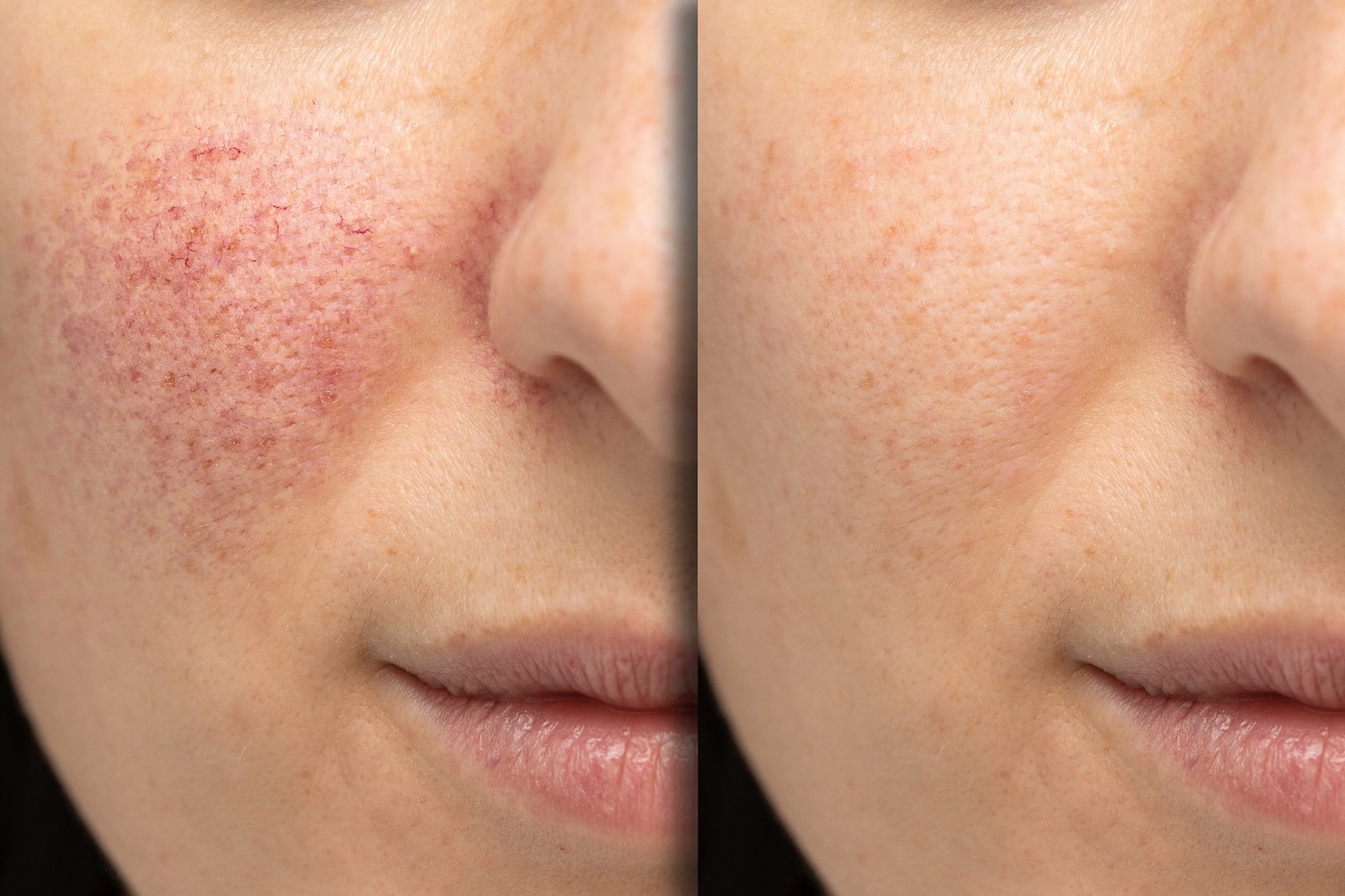 before and after comparison showing reduced redness and smoother skin after laser treatment
