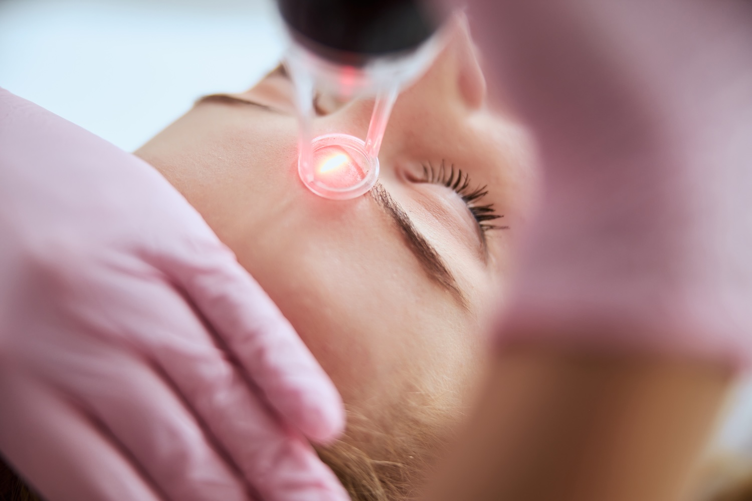 close-up of laser skin rejuvenation treatment being performed on a person’s face