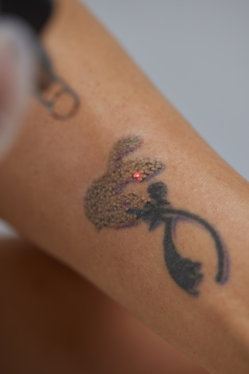 close-up of a laser device targeting a small red spot on a tattooed area of skin