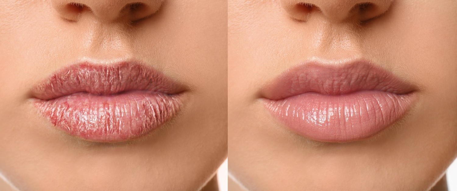 side-by-side close-up of the same lips showing differences in lip surface texture and moisture