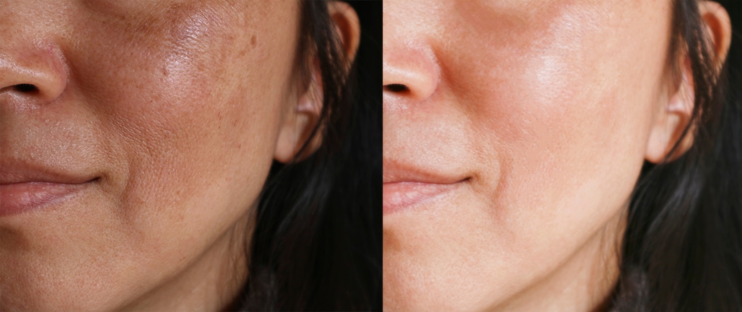 side-by-side close-up of a woman’s cheek and mouth area showing skin texture before and after treatment