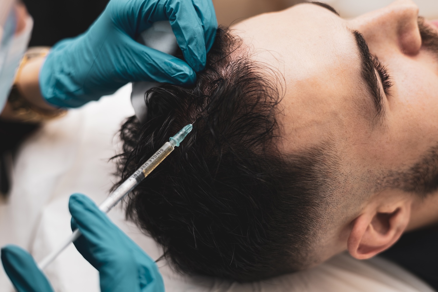gloved hands holding a syringe at a man’s scalp while parting his hair