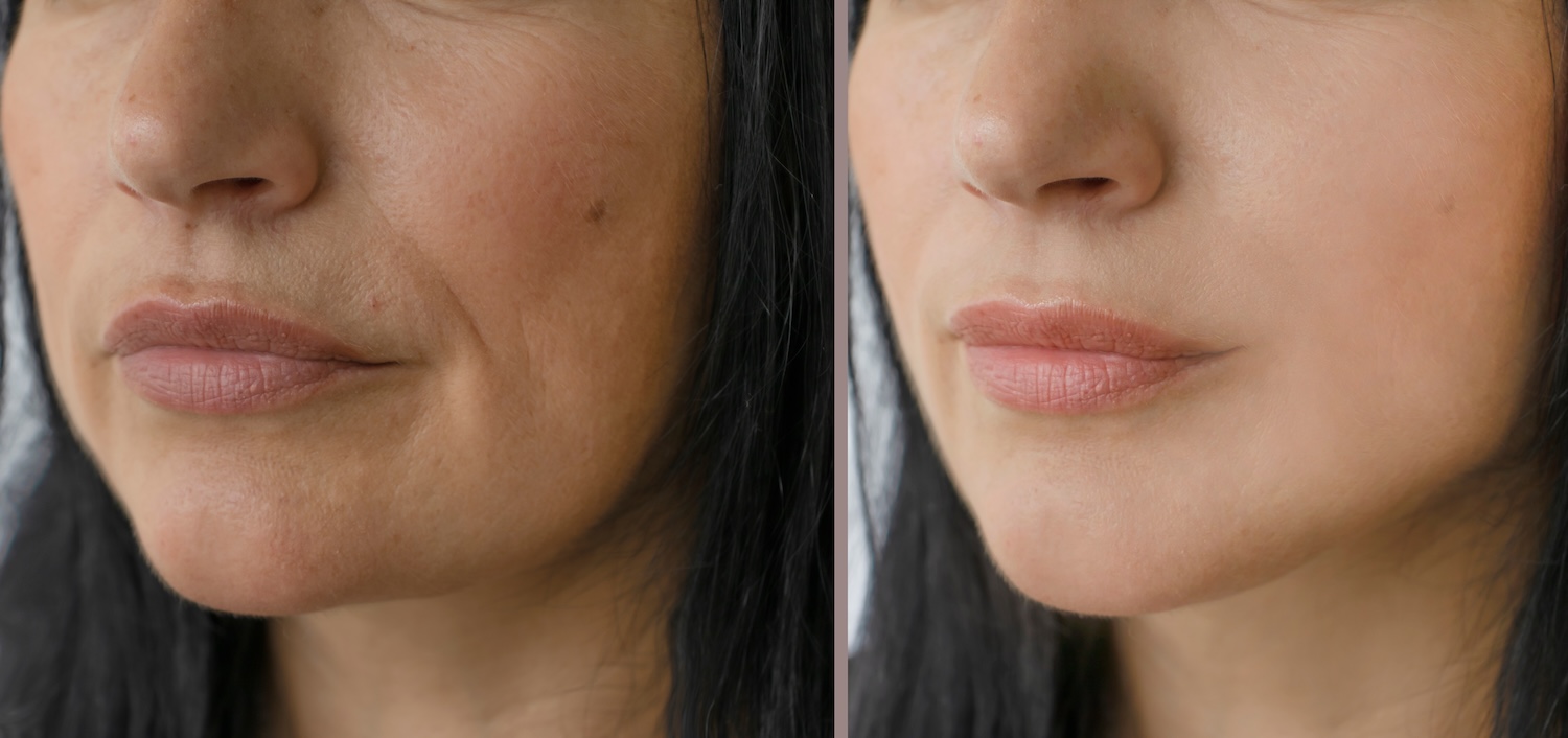 Two side-by-side close-up views of the same person’s lower face, showing the area around the mouth and cheek against a neutral background.