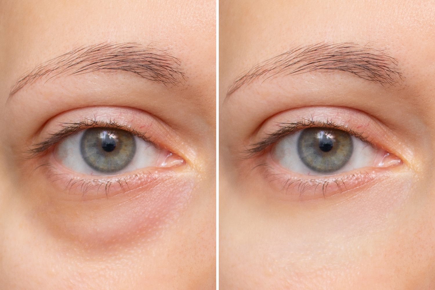 side-by-side close-up of the same under-eye area showing changes in skin texture beneath one eye