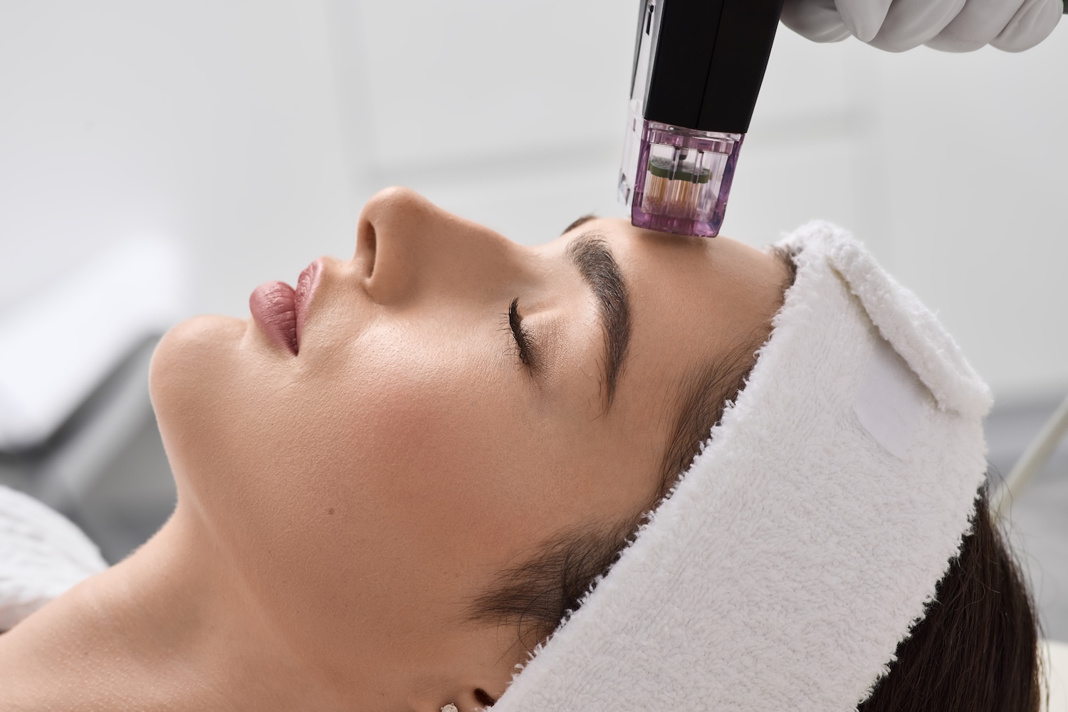 A microneedling device is positioned against a woman’s forehead as she lies down wearing a white headband with eyes closed.