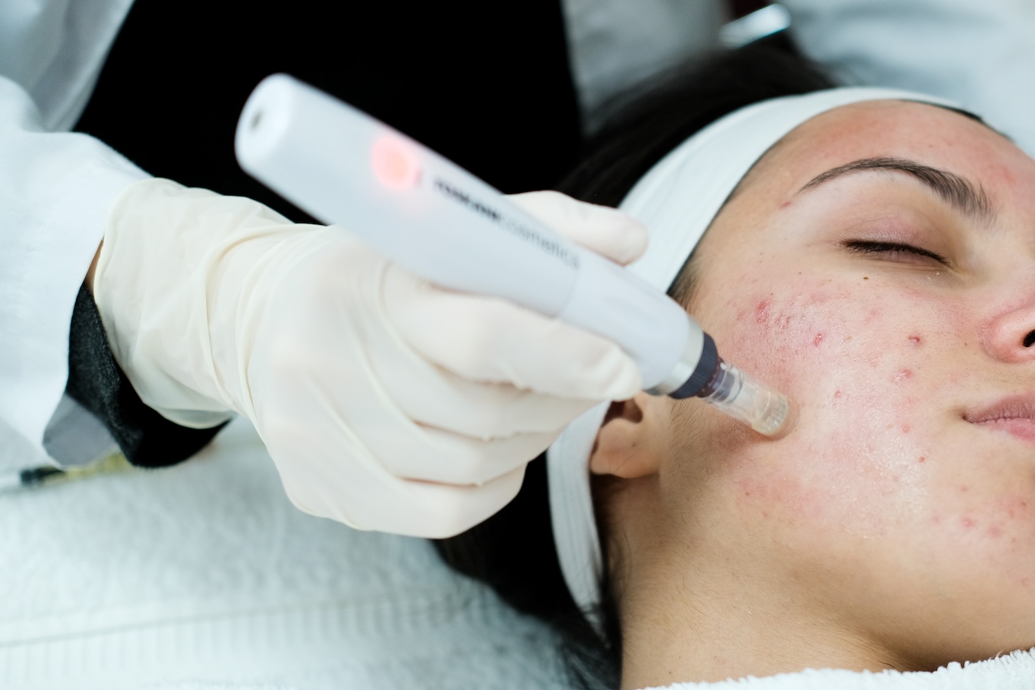 A gloved hand holds a microneedling pen against a woman’s cheek as she lies down wearing a white headband with eyes closed.