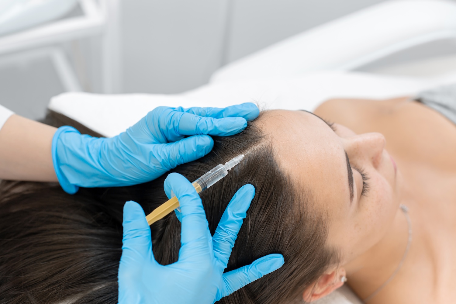 Clinician wearing blue gloves injects a syringe into a patient’s scalp near the front hairline.