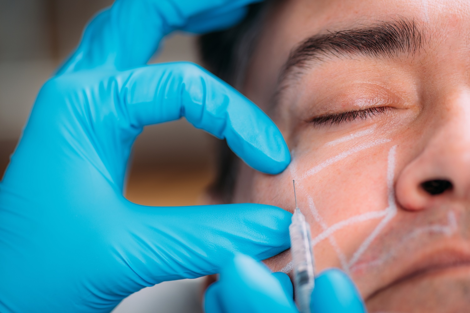 man receiving Revanesse Versa dermal filler injection in the cheek area with treatment markings and gloved injector