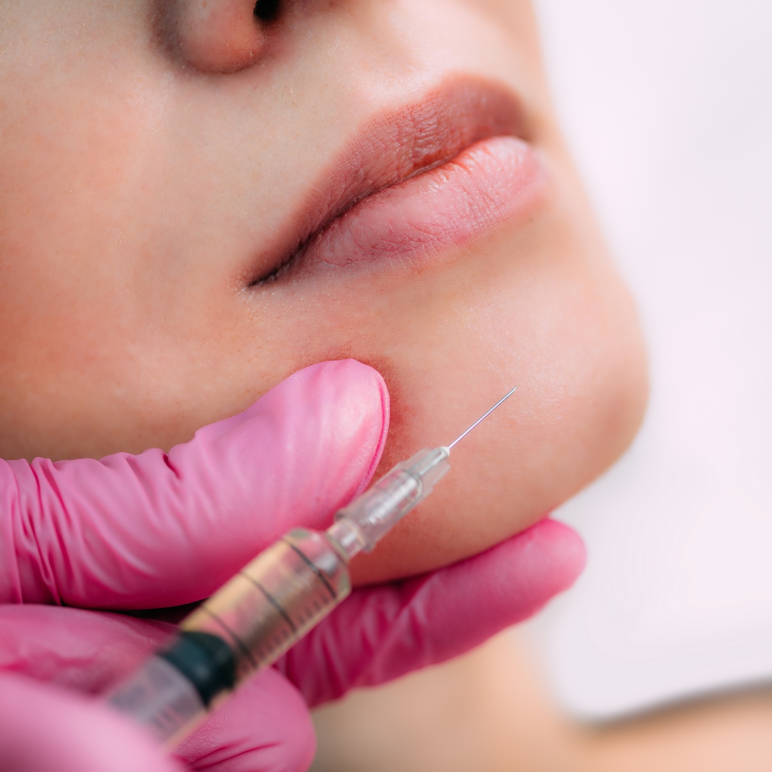 close-up of Revanesse Versa dermal filler injection into the chin area by provider wearing pink gloves